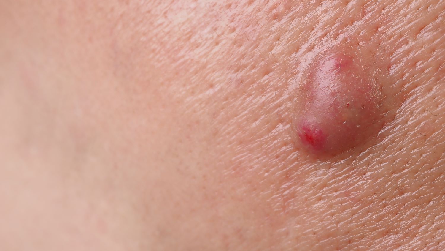 Abscess drainage