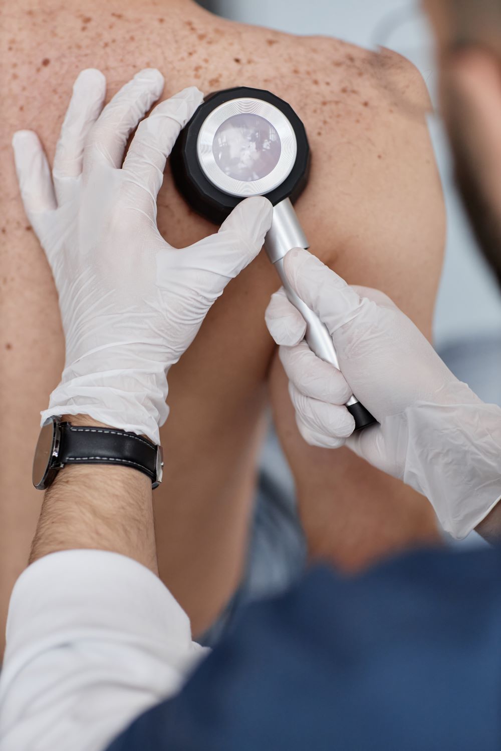 Full-body dermatoscopy