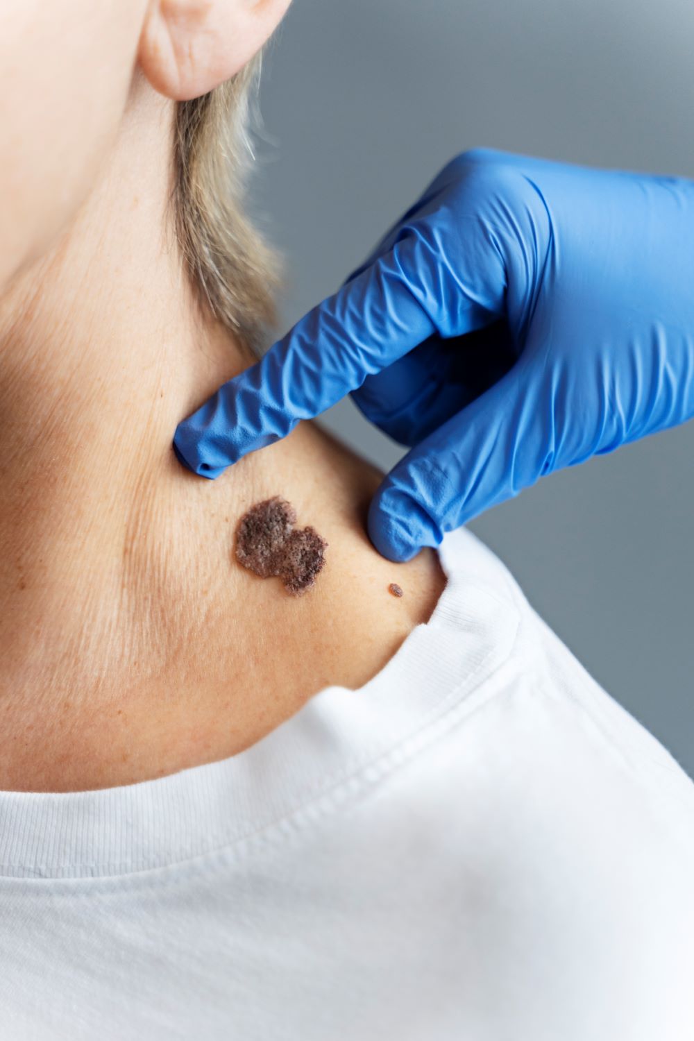 Punch biopsies