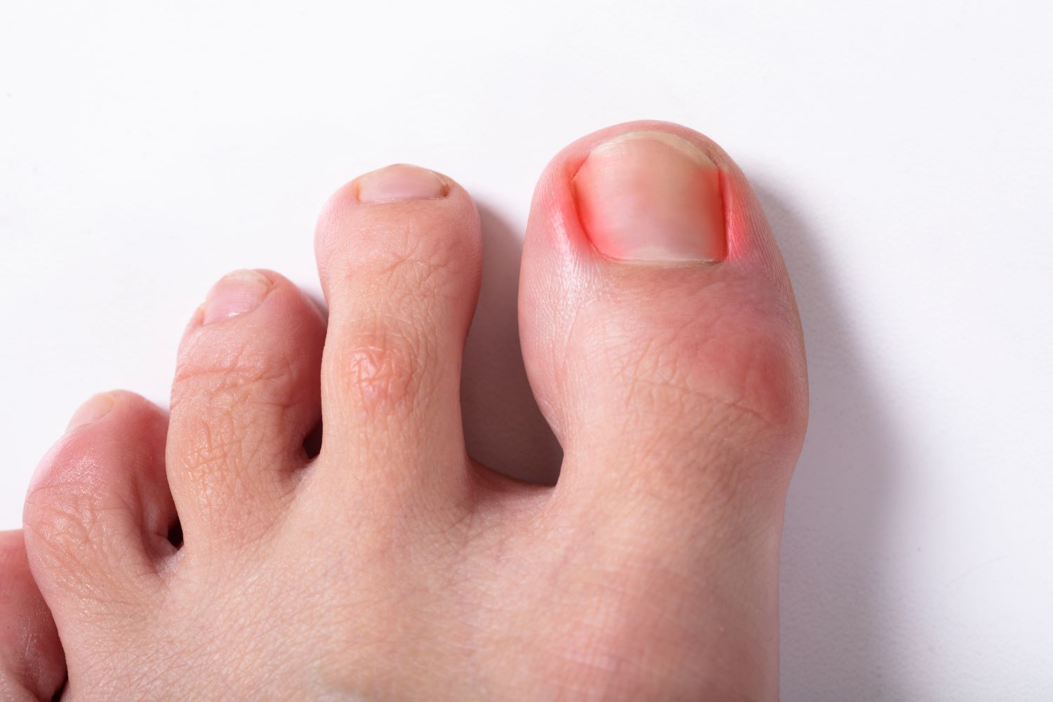 Ingrown toenails